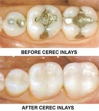 CEREC inlays